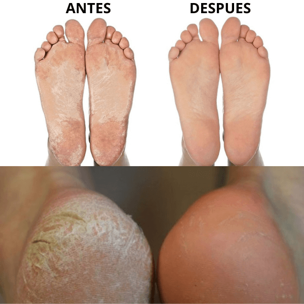 Removedor de Callos – ¡Pies suaves en minutos! 👣